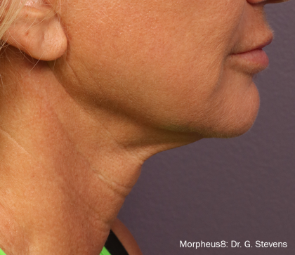Morpheus Before & After Patient #938