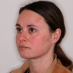 V-Beam Before & After Patient #1583