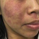 V-Beam Before & After Patient #1584