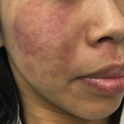 V-Beam Before & After Patient #1584