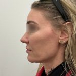 Jowls Bundle Before & After Patient #1576