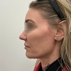 Jowls Bundle Before & After Patient #1576