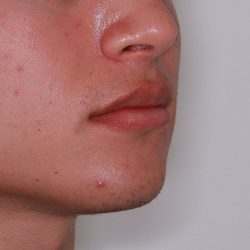 Lip Filler Before & After Patient #1577