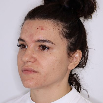 CoolPeel Before & After Patient #1573