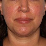 Morpheus8 Before & After Patient #1580