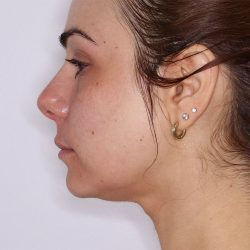 Morpheus8 Before & After Patient #1581