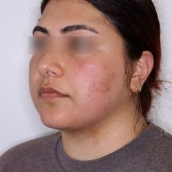PRP Microneedling Before & After Patient #1582