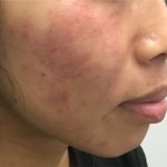 V-Beam Before & After Patient #1584