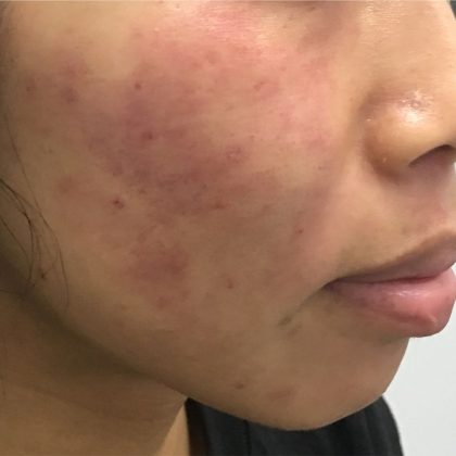 V-Beam Before & After Patient #1584
