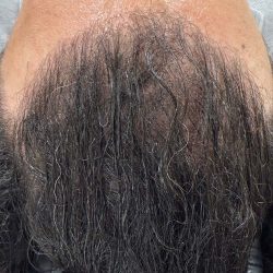Healthy Hair Bundle Before & After Patient #1575
