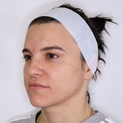 CoolPeel Before & After Patient #1573