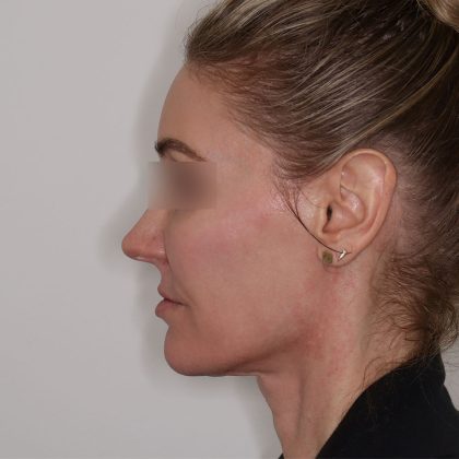 Jowls Bundle Before & After Patient #1576