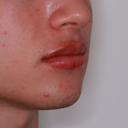 Lip Filler Before & After Patient #1577