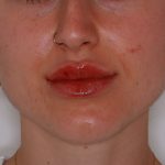 Lip Filler Before & After Patient #1578