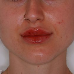 Lip Filler Before & After Patient #1578