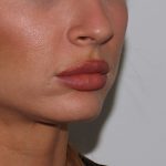 Lip Filler Before & After Patient #1579