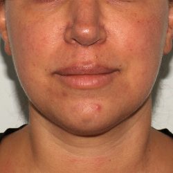 Morpheus8 Before & After Patient #1580