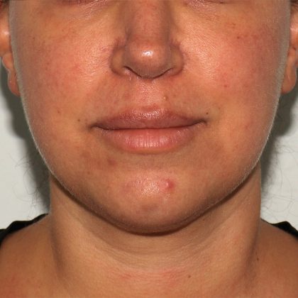 Morpheus8 Before & After Patient #1580