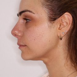 Morpheus8 Before & After Patient #1581