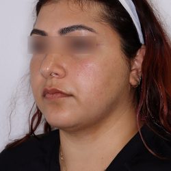 PRP Microneedling Before & After Patient #1582
