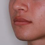 Lip Filler Before & After Patient #1577