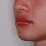 Lip Filler Before & After Patient #1577