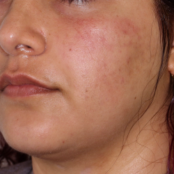 PRP Microneedling Before & After Patient #1653