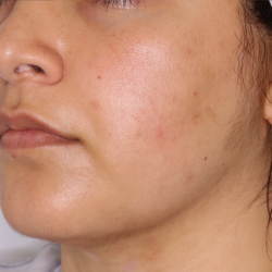 PRP Microneedling Before & After Patient #1653