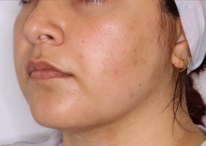 PRP Microneedling Before & After Patient #1653