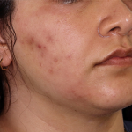 PRP Microneedling Before & After Patient #1653