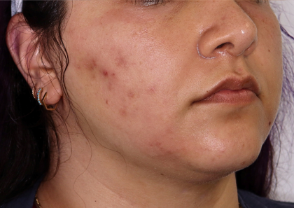 PRP Microneedling Before & After Patient #1653
