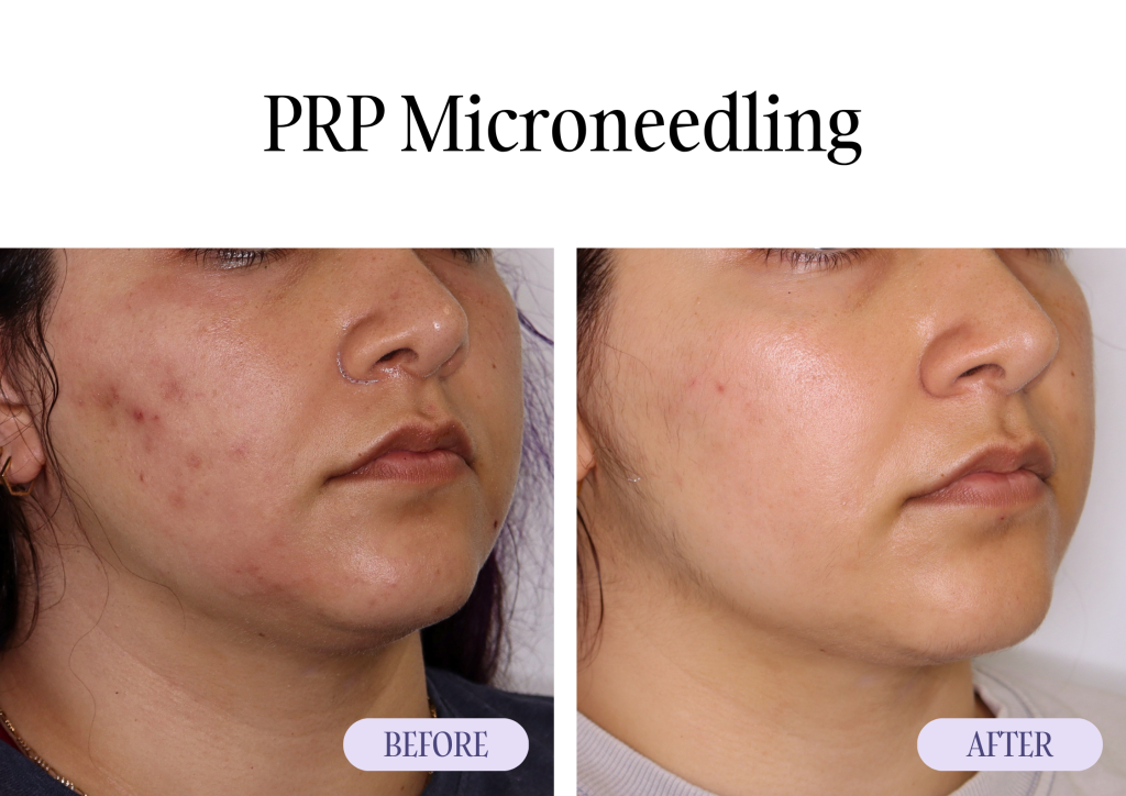PRP Microneedling